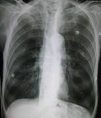 Image result for Emphysema
