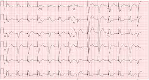 Check the pacing lead (the lead which sends information from the heart to the pacemaker) with an electrocardiogram (ecg) at your doctor's office. Is This Golfer S Pacemaker Malfunctioning Clinician Reviews