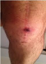 Sometimes sutures from the inside will spit out through the wound. Https Www Gavinpublishers Com Articles Case Report Journal Of Orthopedic Research And Therapy Magnetic Resonance And Ultrasound Imaging Of Intra Tendinous Suture Reaction A Case Series