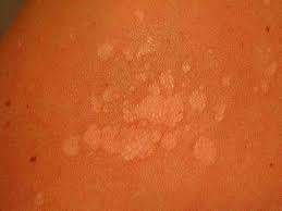 It is usually seen in children, and is most noticeable in those with darkly pigmented skin, although it may occur in all skin types. Tinea Versicolor Symptoms Causes Diagnosis And Treatment