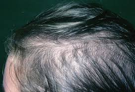 Keeping your hair follicles strong is essential for preventing breakage. Your Hair And Scalp Can Say A Lot About Your Health