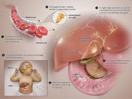 La sindrome di gilbert è una malattia ereditaria che si trasmette in modo autosomico dominante o, più frequentemente, in modo autosomico recessivo (sono necessarie due copie del gene mutato perché la malattia si manifesti). Sindrome Di Crigler Najjar Fondazione Americana Per Il Fegato
