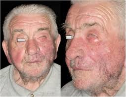 Unusual case of primary cutaneous signet-ring cell (histocytoid) carcinoma 