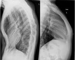 Pectus excavatum is the main cause of rib flare. 140 Anatomical Variants Ideas Radiology Anatomical Radiography