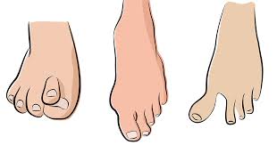 Image result for Hammer toe