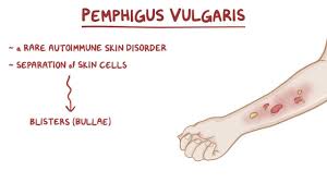 Image result for Pemphigus