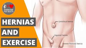 Image result for Inguinal hernia man