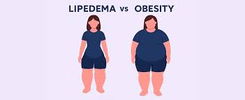 Image result for Obesity