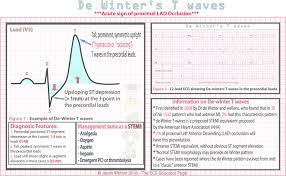 Ecg abnormality described by de winter et al. De Winter S T Waves Acute Sign Of Proximal Lad Occlusion Grepmed