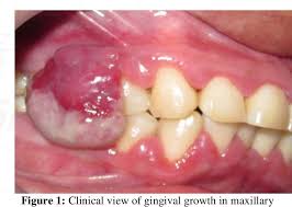 Image result for granuloma gum disease
