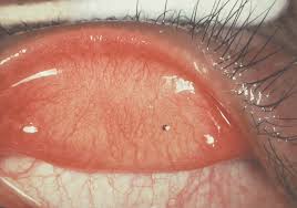 Image result for Eye Foreign Body