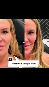 Heather Gay's Temple Filler Transformation Revealed
