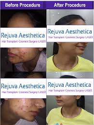 How do you get started finding the right cosmetic surgeon for you? Skinskin Resurfacing Doctor Near Me With Fees Rejuvaaesthetica Com By Rejuvaaesthetica Care Medium