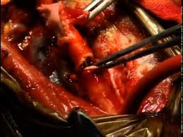 Ucla Vascular Surgery Carotid Endarterectomy Procedure 2 M4v Vascular Surgery Harvard Medical School Surgery