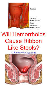 Pin On Hemorrhoids Remedie