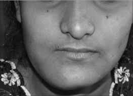Curettage and bone graft for aneurysmal bone cyst. Aneurysmal Bone Cyst Rarity In Mandible And Its Ambiguity With Central Giant Cell Granuloma Shete A Chavan M Diwan N Shete M J Orofac Sci