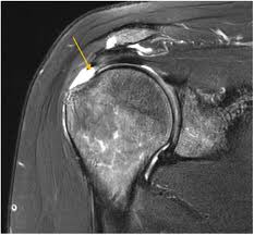 Image result for Shoulder MRI