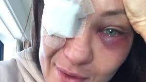 Zobacz najciekawsze publikacje na temat: Powazna Kontuzja Karoliny Kowalkiewicz Strasza Mnie Ze Moglabym Stracic Wzrok Polsat News
