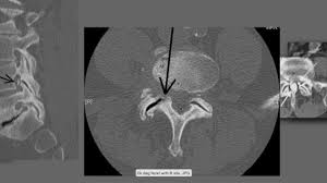 The back muscles are anatomically layered into superficial (extrinsic) and deep (intrinsic) muscles. How To Read The Ct Scans How To Read Ct Myelograms How To Read Spine Imaging Youtube