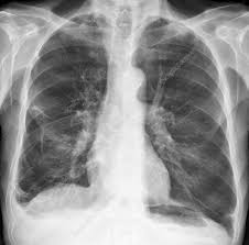Image result for Emphysema