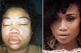 Dermatology & skin diseases : This Lupus Survivor S Skin Dramatically Improved After Making Her Own Beauty Products