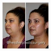 HESSLER PLASTIC SURGERY