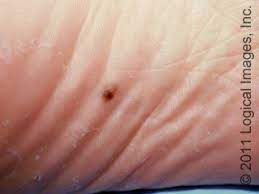 So, what exactly does skin cancer look like? Pin On Projects To Try