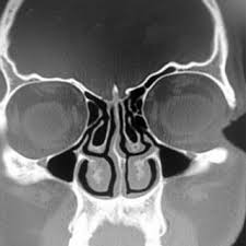 Decongestants are available as a pill or as a nasal spray. Bilateral Concha Bullosa Lt Lamellar Rt Extensive Download Scientific Diagram