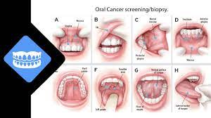 Check spelling or type a new query. Oral Cancer Screening Biopsy Auburn Lakes Periodontics Dental Implants
