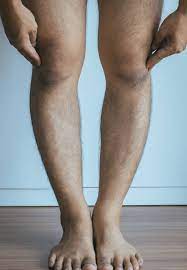 X Bein Und O Bein Fehlstellungen Im Knie Entgegenwirken Gelenk Klinik De