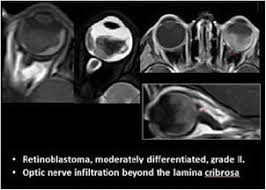 Magnetic resonance imaging (mri) uses a large magnet, radiofrequencies, and a computer to make detailed pictures of organs and structures within the body. Espr 2017 Springerlink