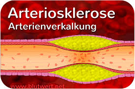 Triglyceride Erhoht Zu Hoch Was Nun