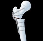 Pediatric LCP Plate System | Products | DePuy Synthes