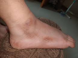 Image result for brown patches on the feet