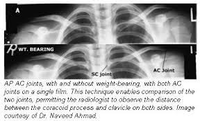 Boning Up On Humerus Clavicle And Ac Joint Positioning Nuclear Medicine Joint X Ray