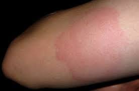 Check spelling or type a new query. Shingles Vaccine India Pdf Ppt Case Reports Symptoms Treatment