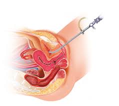 Hematuria Harvard Health