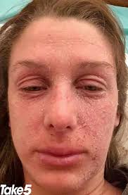 My eczema flared up after stopping steroids, before my wedding