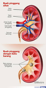 Apabila batu karang ini berpindah dari buah pinggang ke pundi kencing melalui tiub yang dipanggil ureter, pesakit mengalami rasa sakit pada abdomen bawah. Elak Sakit Batu Karang