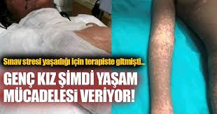 Psikiyatristin Verdigi Ilaclari Kullanan Genc Kiz Yasam Savasi Veriyor En Son Haber