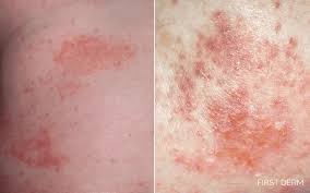 Image result for dermatitis contacta children