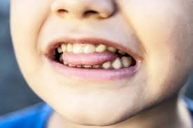 Afbeeldingsresultaat voor afwijkende mondgewoonten