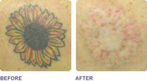 Tattoo removal can be more an art than an exact science, so it can be difficult to identify the exact number of treatments that will be needed to remove a tattoo completely. Tattoo Removal Bali Advertiser