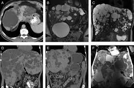 Treatment Of Polycystic Liver Disease One Size Does Not Fit All American Journal Of Kidney Diseases