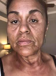 Client of Esthetician Tanya McCutcheon from About Face By Tanya located in  Seabrooke, Texas. Her client is absolutely delighted at the transformation  of her skin.