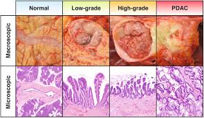 The aims of treatment are to establish a diagnosis, and to manage symptoms and complications (table 3) medically or surgically. Early Detection Of Pancreatic Cancer Opportunities And Challenges Gastroenterology