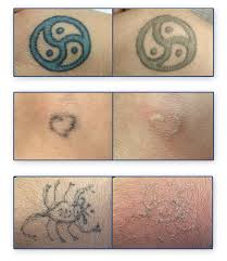 As such it has fallen into our specialist area of cosmetic treatments, and we're finding more and more of our patients in airdrie, alberta and calgary are relying on us to provide them with quality service for tattoo removals. Maret 2017 Get Tattoo Removal Method