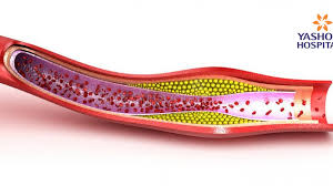 Maybe you would like to learn more about one of these? Blocked Arteries 5 Tips To Slow The Process Down