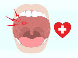 It is a fairly common, sudden onset and benign blood blistering oral (mouth) disorder. 3 Ways To Get Rid Of Mouth Blisters Wikihow