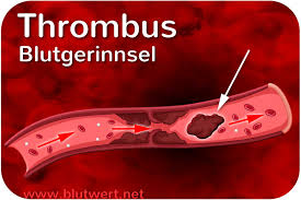 Dyb venøs trombose (dvt) og lungeemboli (le) forekommer i 1 af 1000 graviditeter og er den hyppigste årsag til maternel død i usa. Blutgerinnsel Thrombus